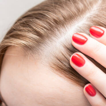 woman with hair loss
