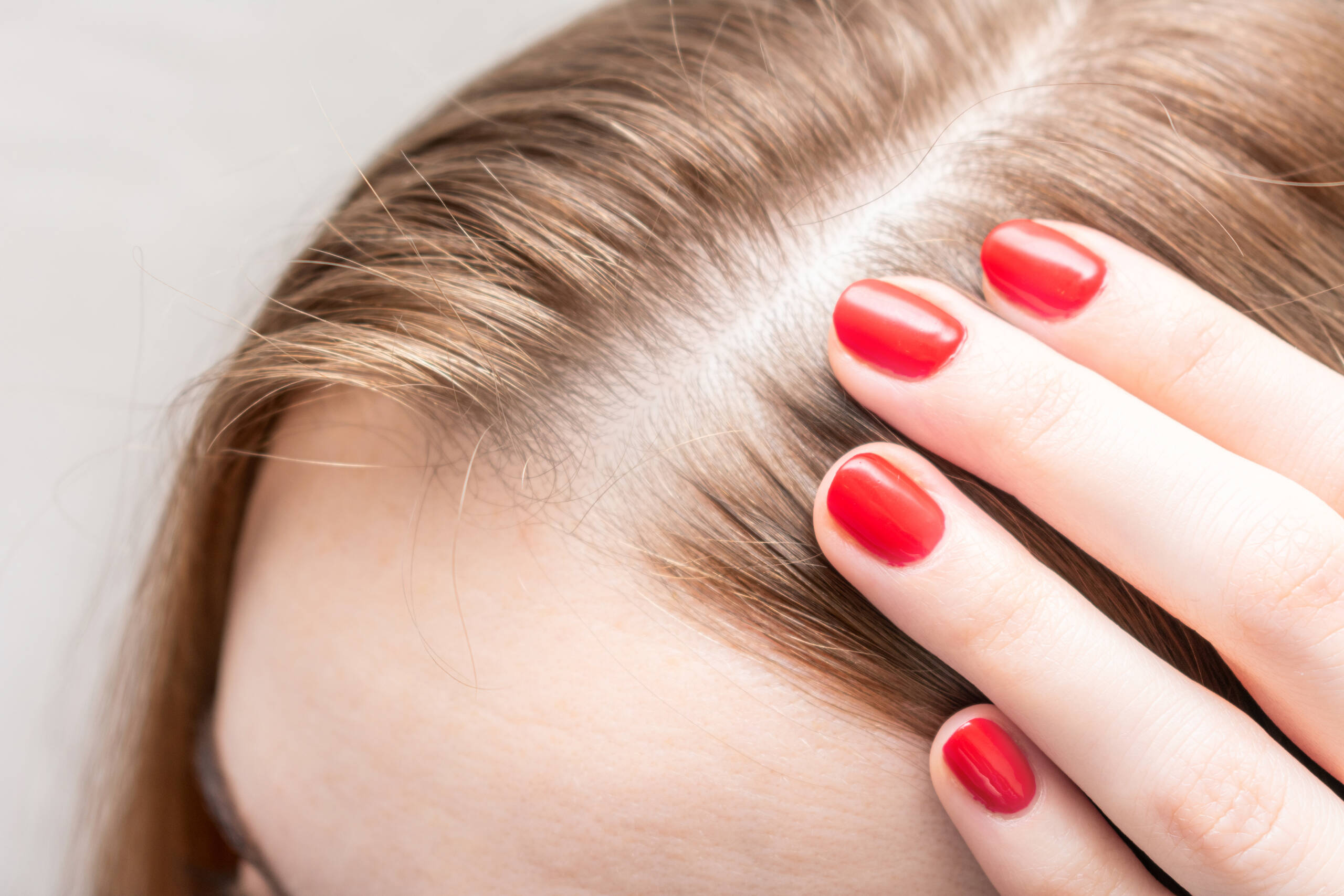 Non-Ulotic Alopecia