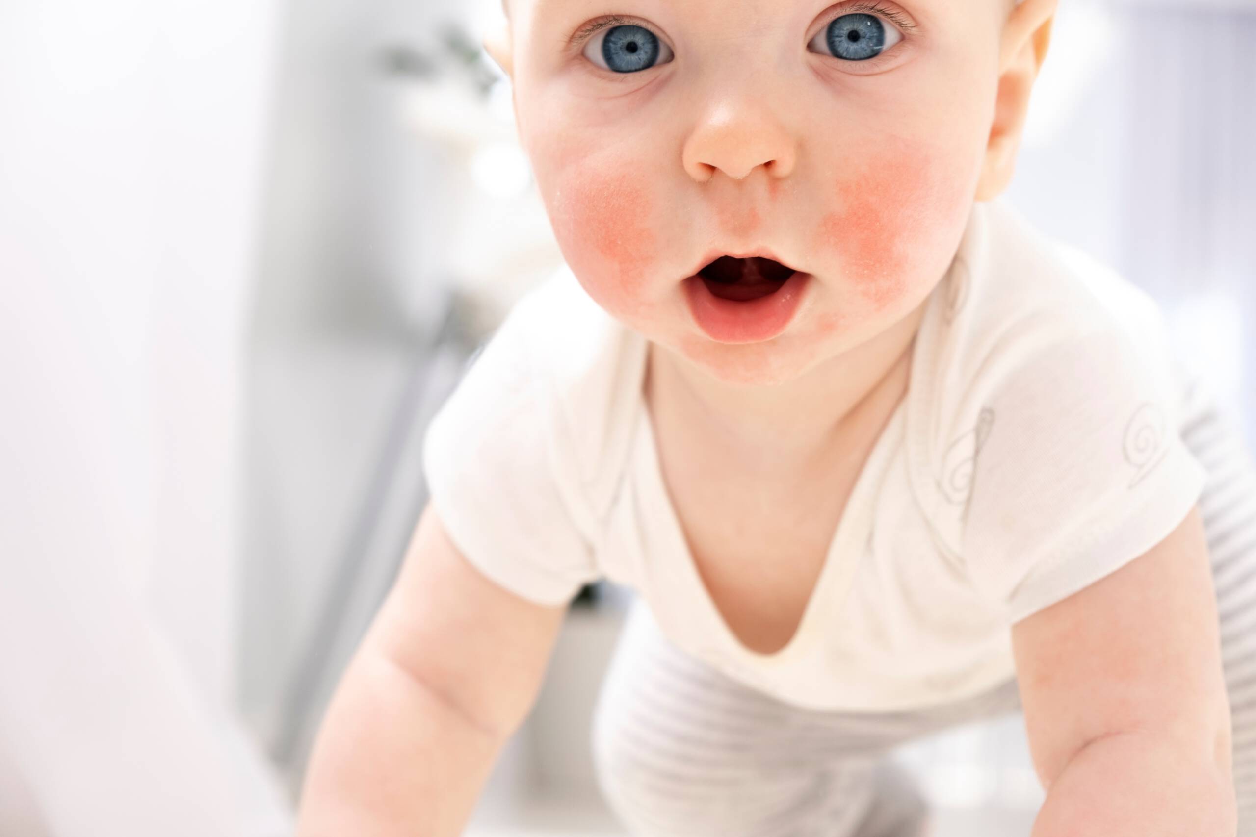 Atopical Dermatitis (children)